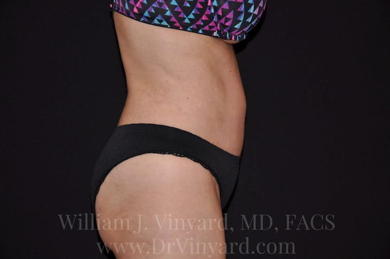 Tummy Tuck Before & After Gallery - Patient 171441910 - Image 6