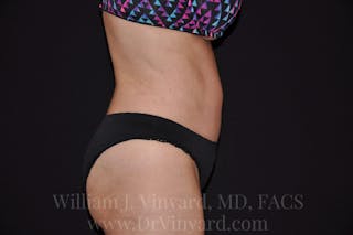 Tummy Tuck Before & After Gallery - Patient 171441910 - Image 6