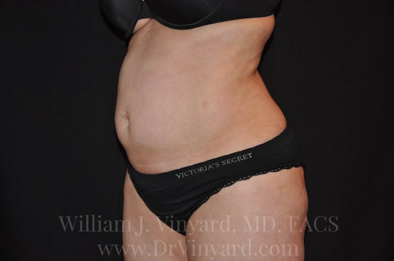 Tummy Tuck Before & After Gallery - Patient 171441910 - Image 7