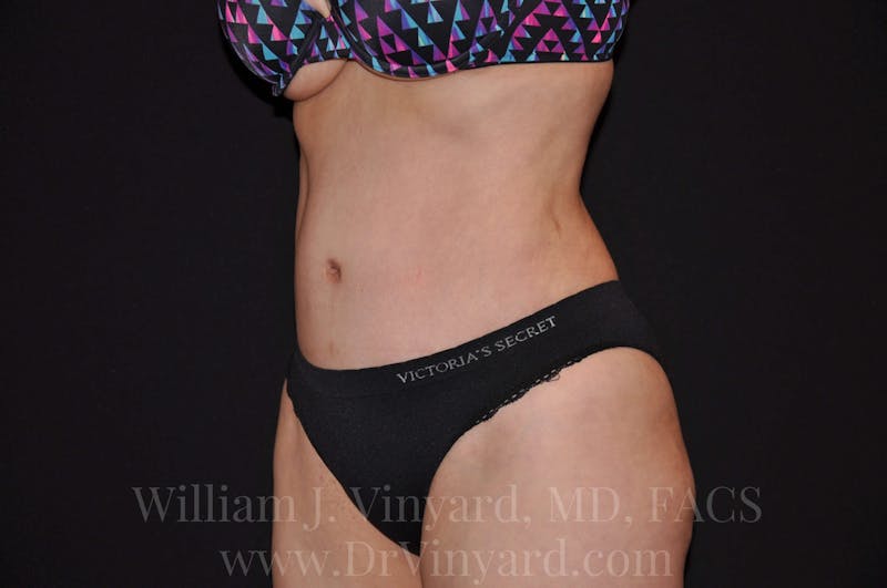Tummy Tuck Before & After Gallery - Patient 171441910 - Image 8