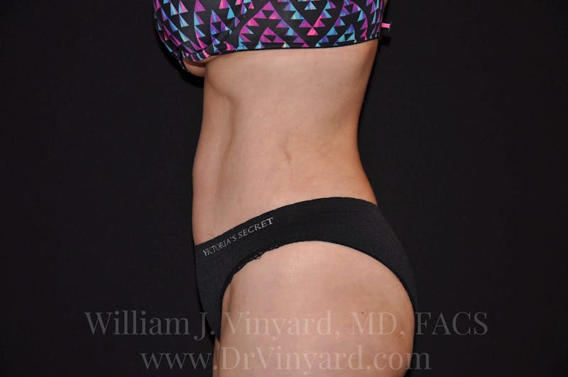 Tummy Tuck Before & After Gallery - Patient 171441910 - Image 10