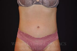 Tummy Tuck Before & After Gallery - Patient 171442038 - Image 2