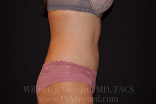 Tummy Tuck Before & After Gallery - Patient 171442038 - Image 6