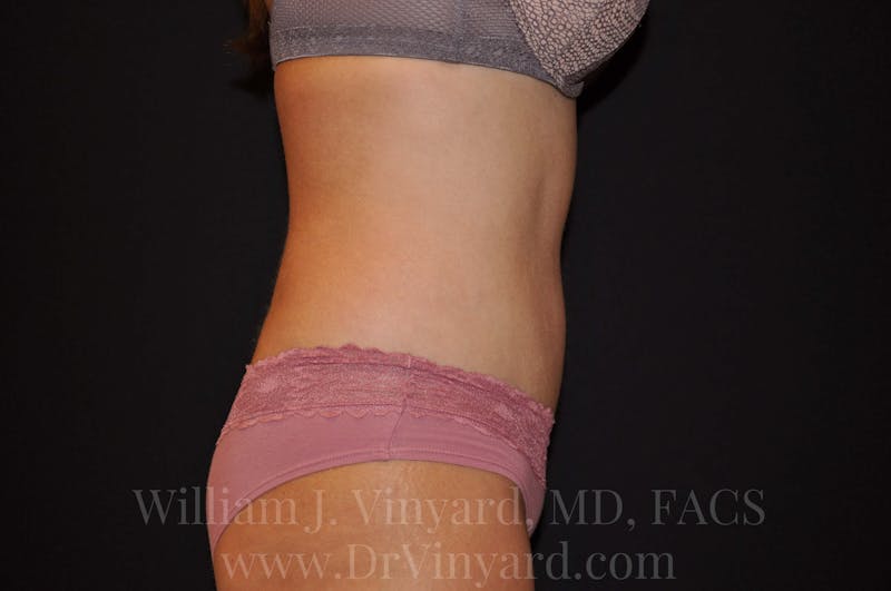 Tummy Tuck Before & After Gallery - Patient 171442038 - Image 6