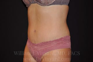 Tummy Tuck Before & After Gallery - Patient 171442038 - Image 8