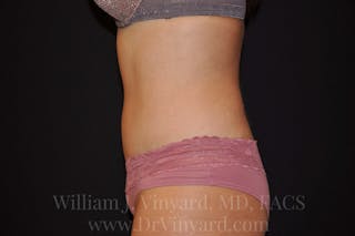 Tummy Tuck Before & After Gallery - Patient 171442038 - Image 10