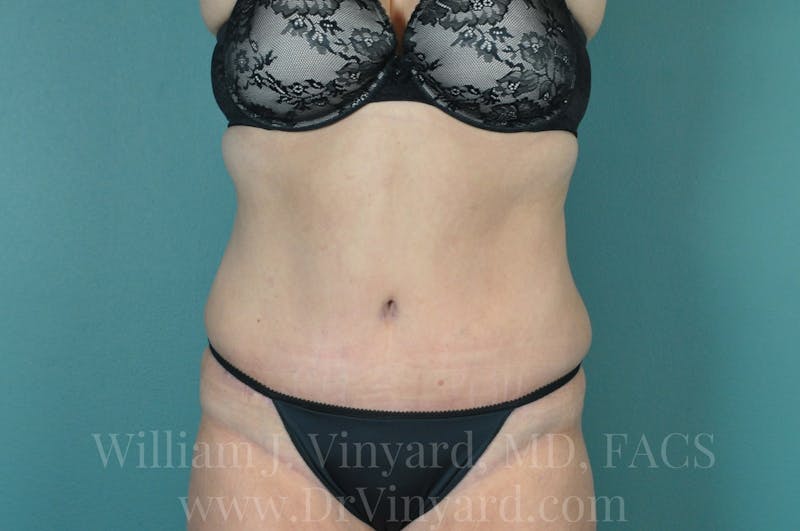 Tummy Tuck Before & After Gallery - Patient 171442050 - Image 2