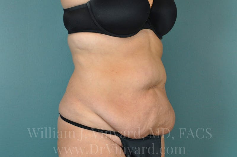 Tummy Tuck Before & After Gallery - Patient 171442050 - Image 3