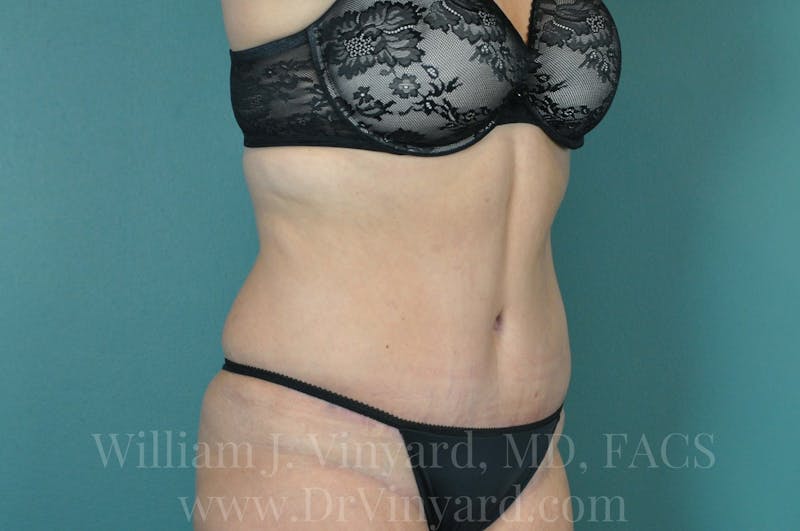 Tummy Tuck Before & After Gallery - Patient 171442050 - Image 4