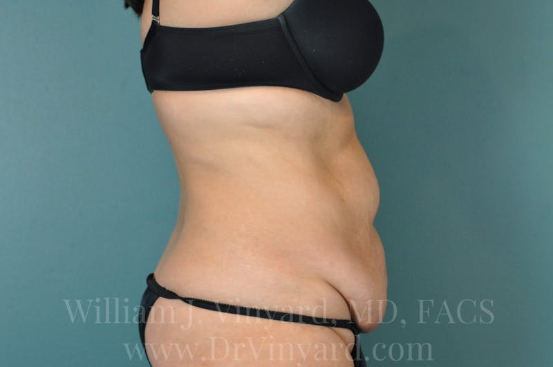 Tummy Tuck Before & After Gallery - Patient 171442050 - Image 5