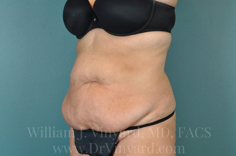 Tummy Tuck Before & After Gallery - Patient 171442050 - Image 7