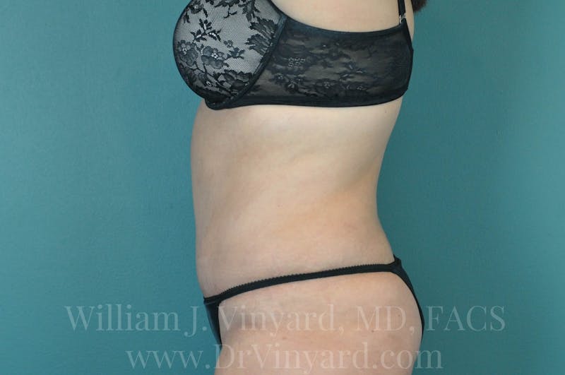 Tummy Tuck Before & After Gallery - Patient 171442050 - Image 10