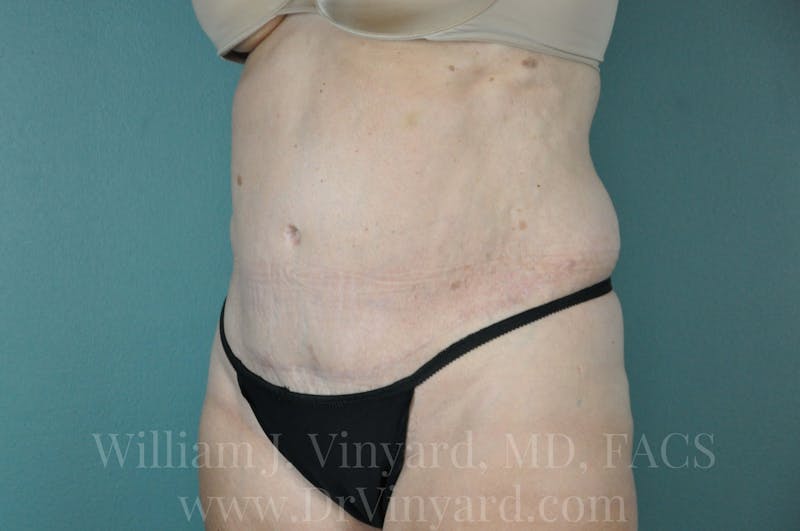 Tummy Tuck Before & After Gallery - Patient 171442148 - Image 8