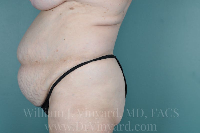 Tummy Tuck Before & After Gallery - Patient 171442148 - Image 9