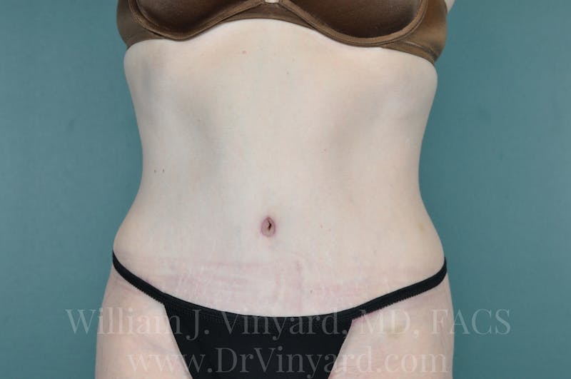 Tummy Tuck Before & After Gallery - Patient 171442578 - Image 2