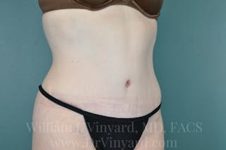 Tummy Tuck Before & After Gallery - Patient 171442578 - Image 4