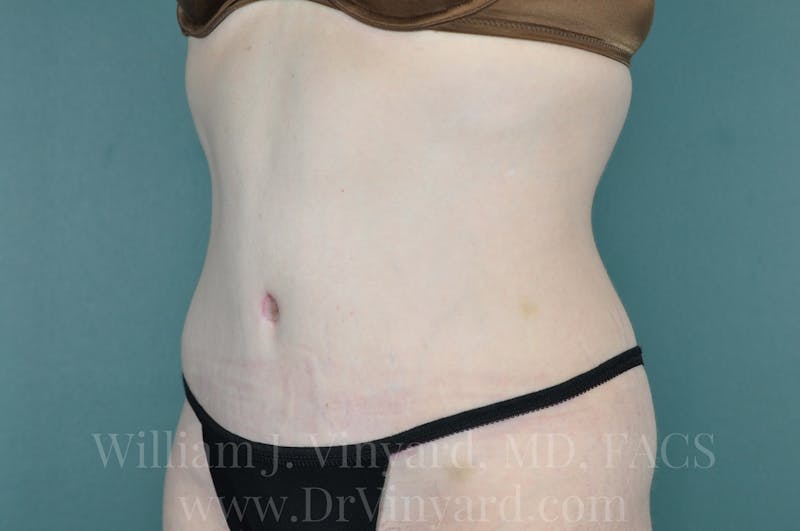 Tummy Tuck Before & After Gallery - Patient 171442578 - Image 8