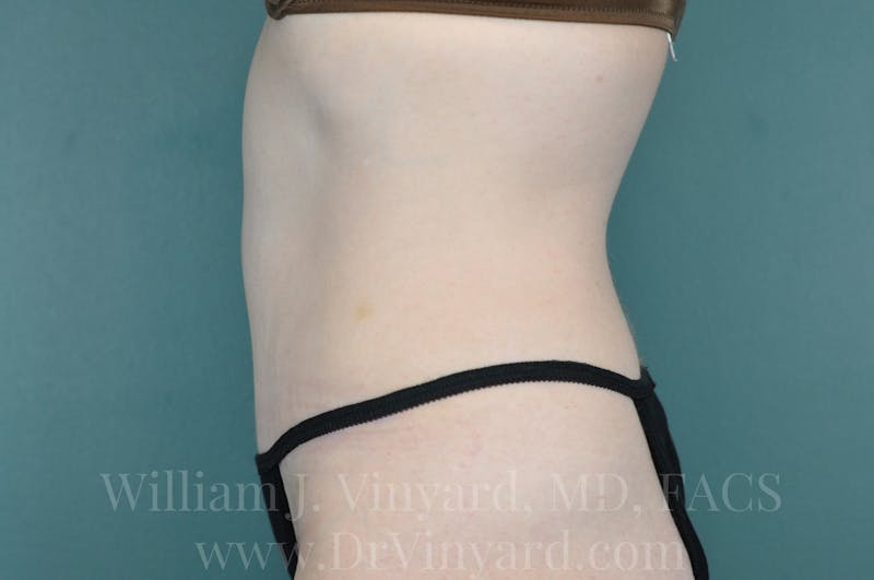 Tummy Tuck Before & After Gallery - Patient 171442578 - Image 10