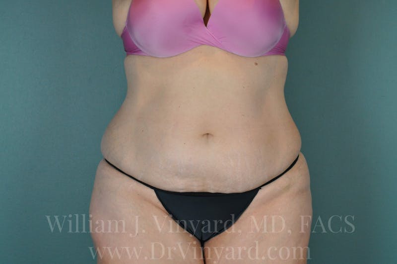 Tummy Tuck Before & After Gallery - Patient 171442597 - Image 1