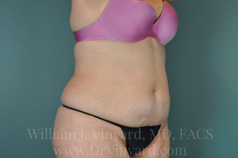 Tummy Tuck Before & After Gallery - Patient 171442597 - Image 3