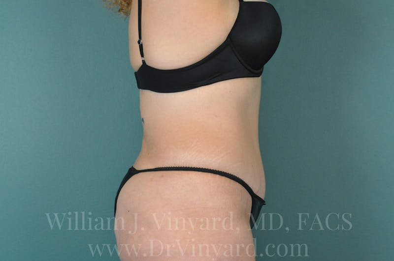 Tummy Tuck Before & After Gallery - Patient 171442597 - Image 6