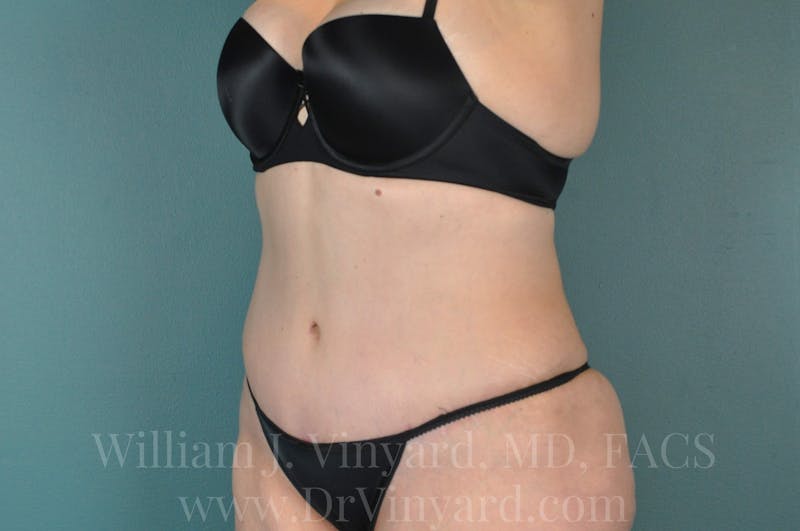 Tummy Tuck Before & After Gallery - Patient 171442597 - Image 8