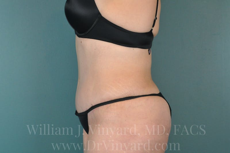 Tummy Tuck Before & After Gallery - Patient 171442597 - Image 10