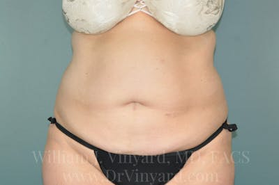 Tummy Tuck Before & After Gallery - Patient 171442609 - Image 1