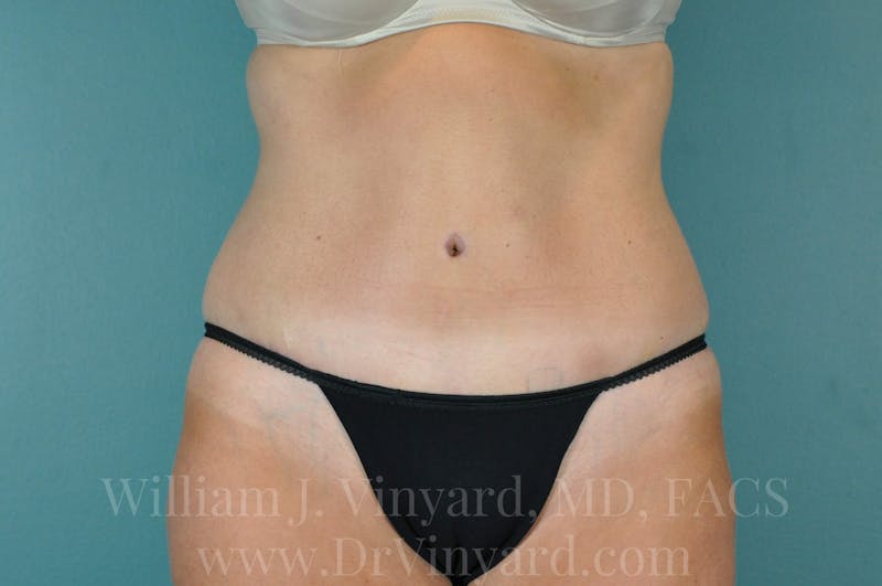 Tummy Tuck Before & After Gallery - Patient 171442609 - Image 2