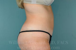Tummy Tuck Before & After Gallery - Patient 171442609 - Image 6