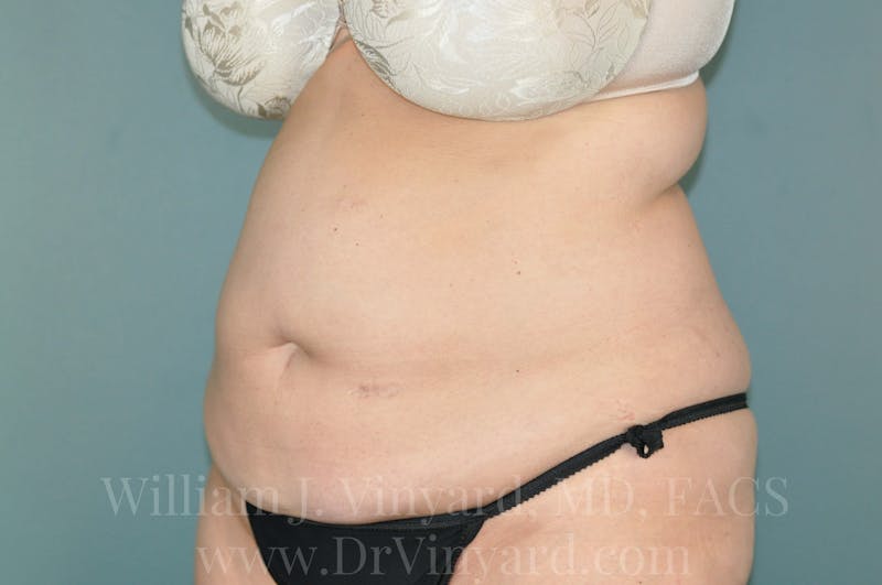 Tummy Tuck Before & After Gallery - Patient 171442609 - Image 7