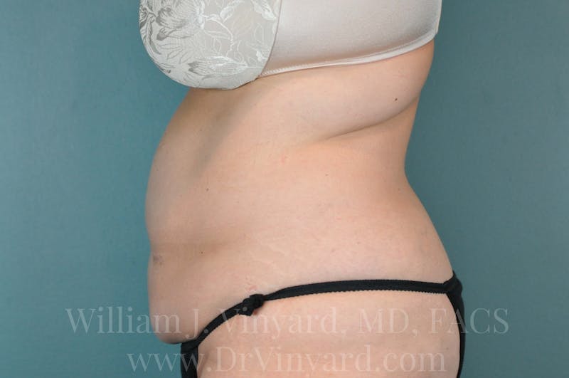 Tummy Tuck Before & After Gallery - Patient 171442609 - Image 9