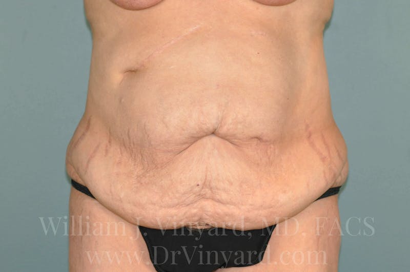 Tummy Tuck Before & After Gallery - Patient 171442622 - Image 1