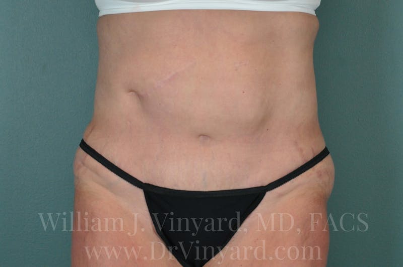 Tummy Tuck Before & After Gallery - Patient 171442622 - Image 2