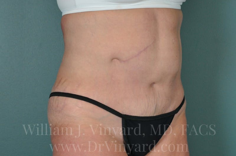 Tummy Tuck Before & After Gallery - Patient 171442622 - Image 4