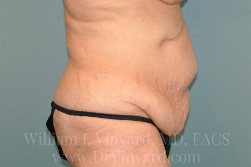 Tummy Tuck Before & After Gallery - Patient 171442622 - Image 5