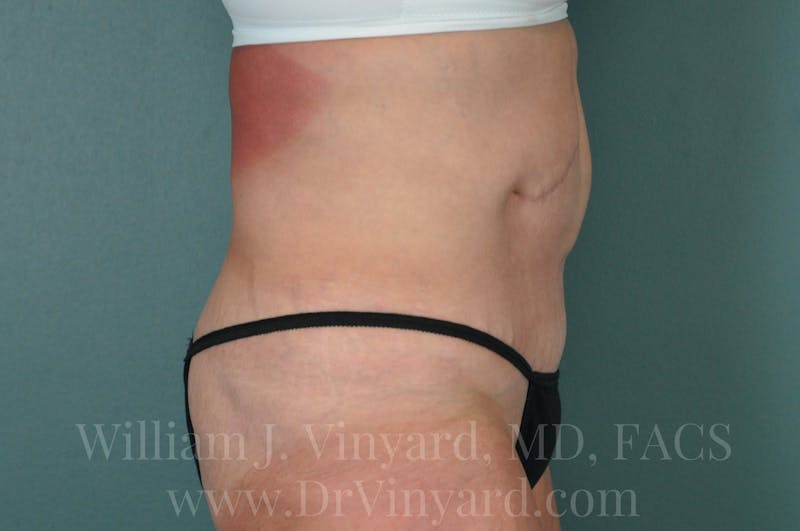 Tummy Tuck Before & After Gallery - Patient 171442622 - Image 6