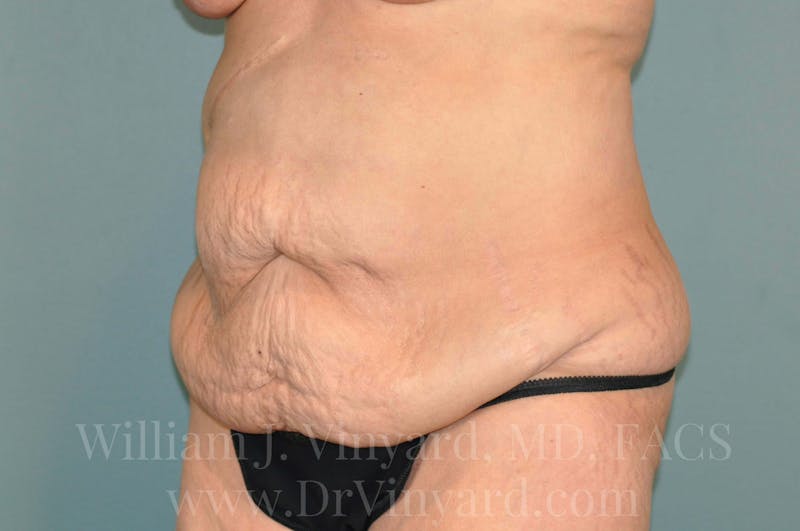 Tummy Tuck Before & After Gallery - Patient 171442622 - Image 7