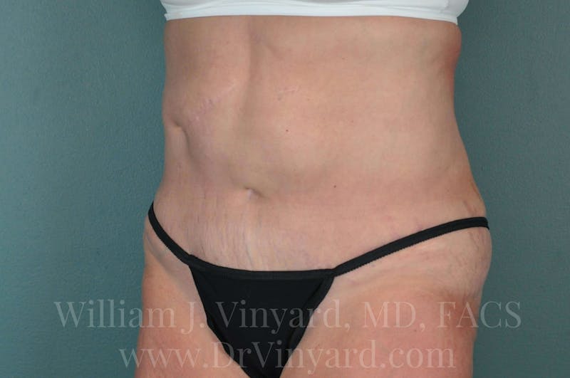 Tummy Tuck Before & After Gallery - Patient 171442622 - Image 8