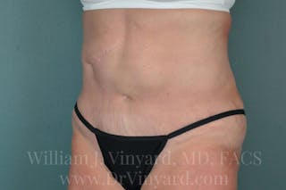 Tummy Tuck Before & After Gallery - Patient 171442622 - Image 8