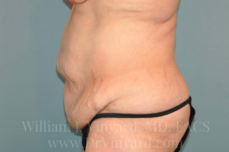 Tummy Tuck Before & After Gallery - Patient 171442622 - Image 9
