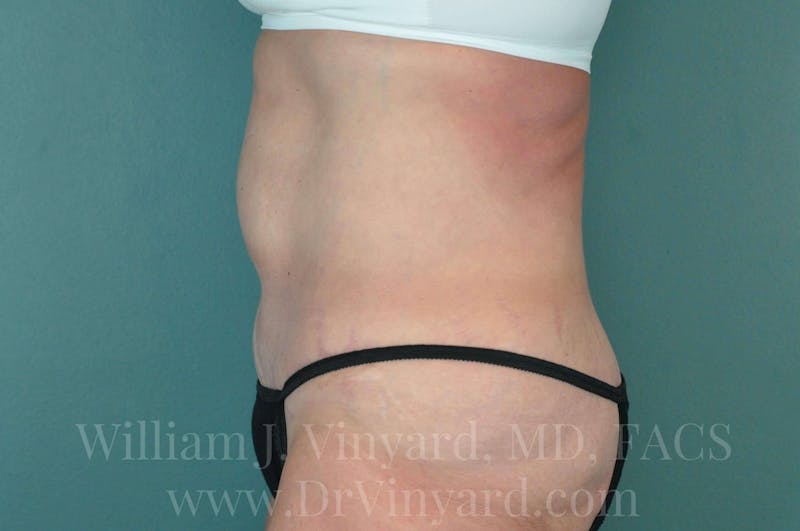 Tummy Tuck Before & After Gallery - Patient 171442622 - Image 10