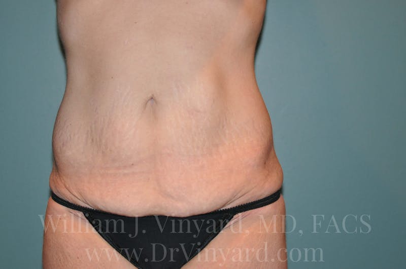 Tummy Tuck Before & After Gallery - Patient 171442980 - Image 1