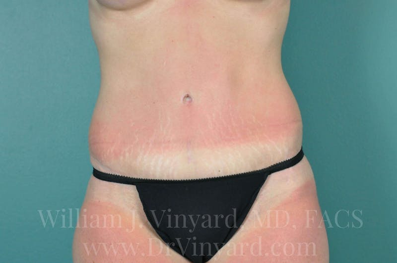 Tummy Tuck Before & After Gallery - Patient 171442980 - Image 2
