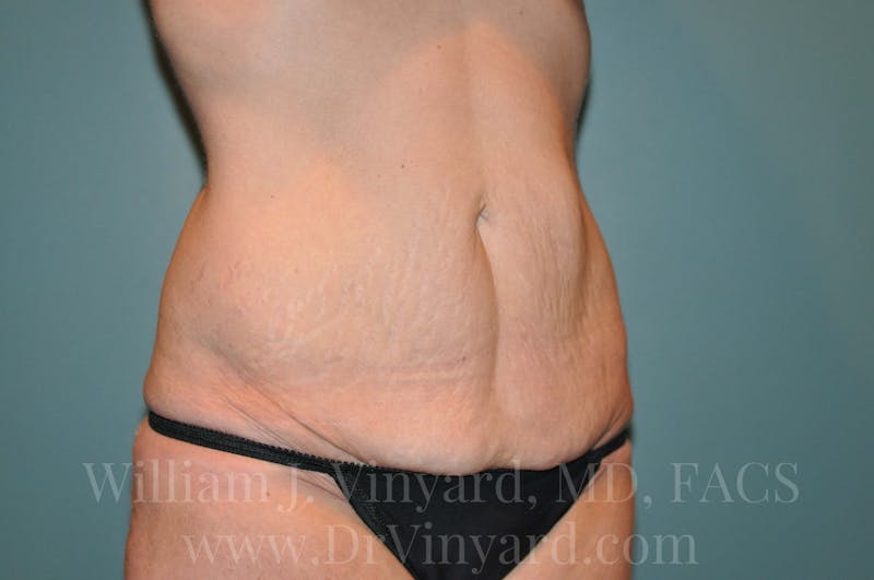 Tummy Tuck Before & After Gallery - Patient 171442980 - Image 3