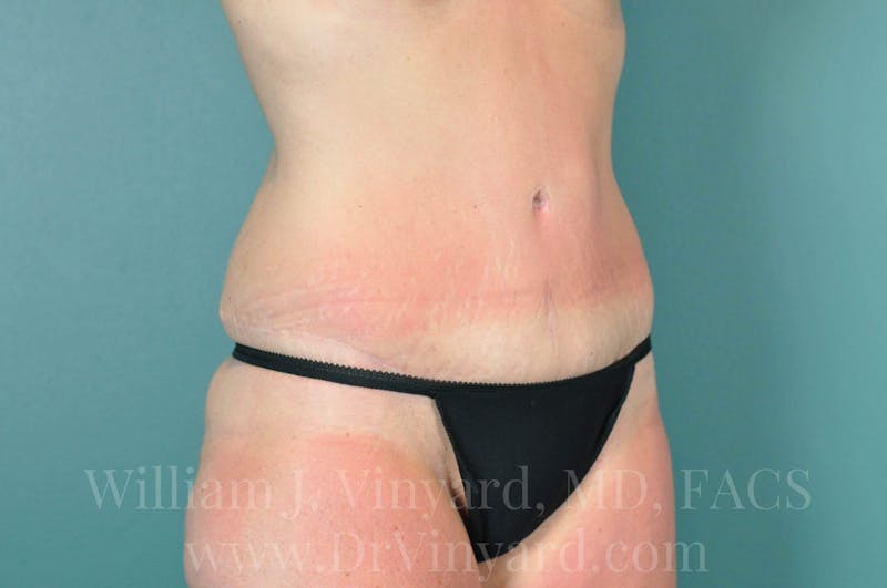 Tummy Tuck Before & After Gallery - Patient 171442980 - Image 4