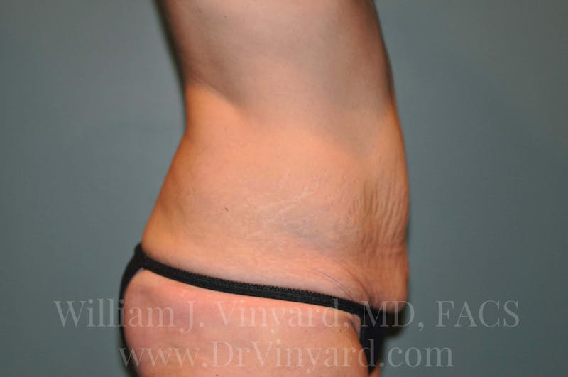 Tummy Tuck Before & After Gallery - Patient 171442980 - Image 5
