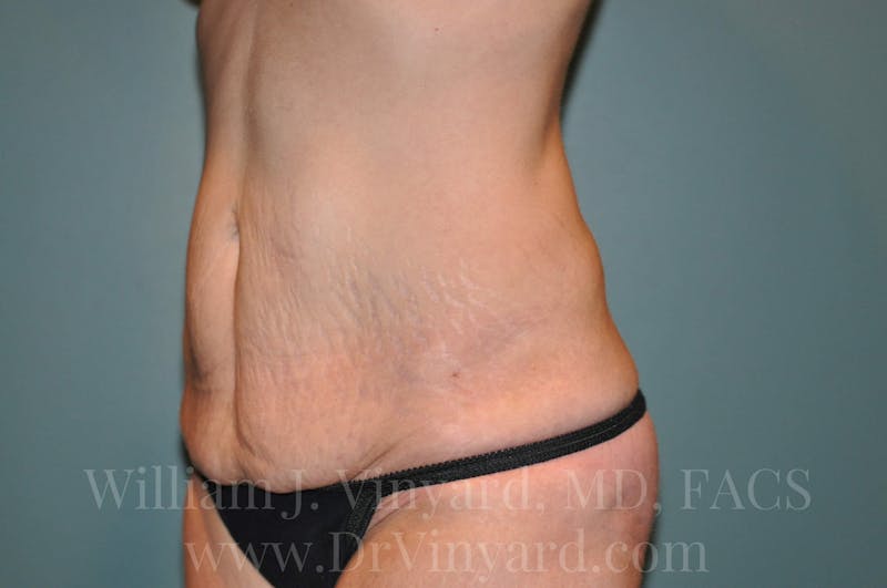 Tummy Tuck Before & After Gallery - Patient 171442980 - Image 7