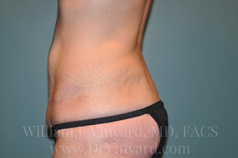 Tummy Tuck Before & After Gallery - Patient 171442980 - Image 9