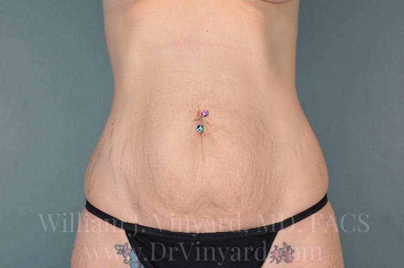 Tummy Tuck Before & After Gallery - Patient 171443133 - Image 1